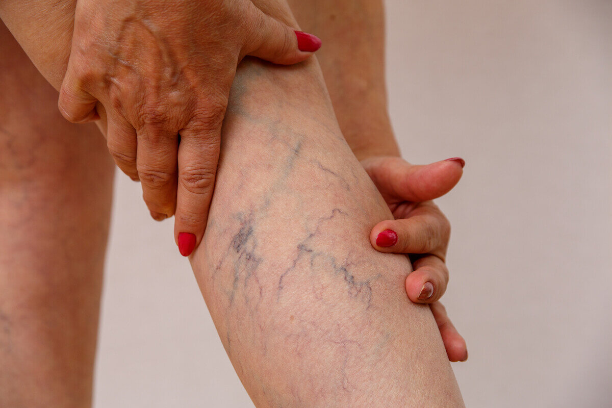 The risk of blood clots from varicose veins