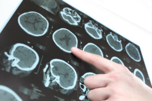 MRI Detecting Brain Aneurism