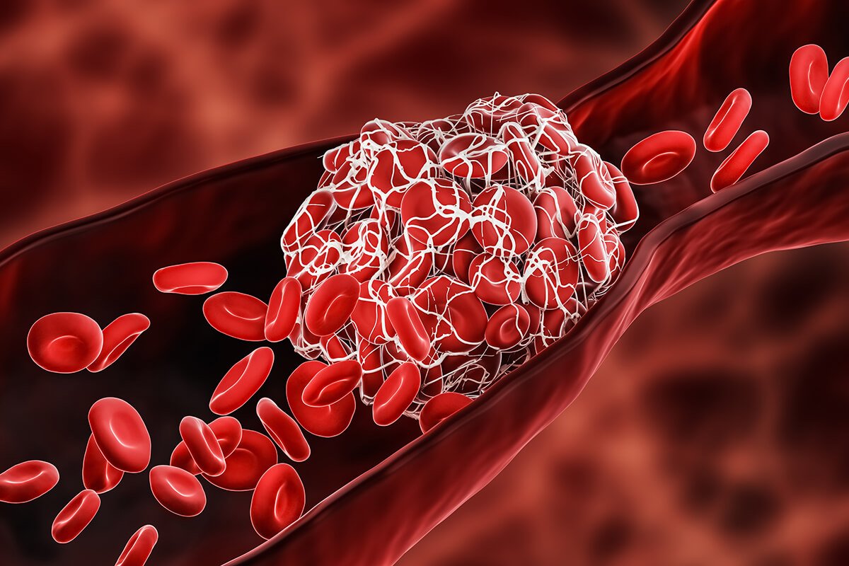 Thrombogenicity inner lining blood vessel