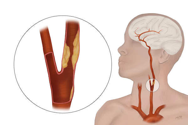 TransCarotid Artery Revascularization