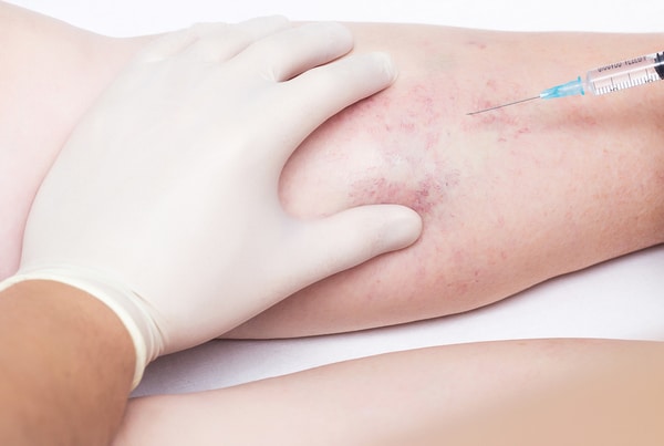 Sclerotherapy