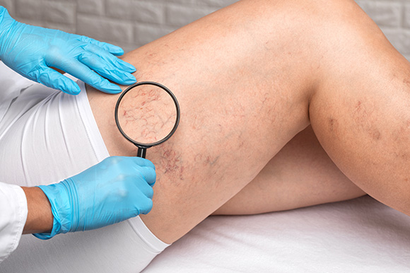 Are Spider Veins and Varicose Veins the Same Thing