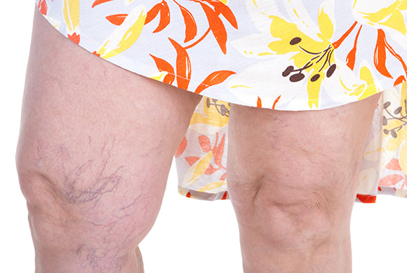 Spider Veins