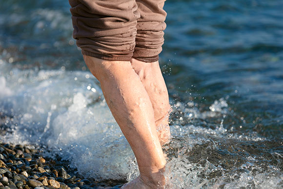Varicose Veins