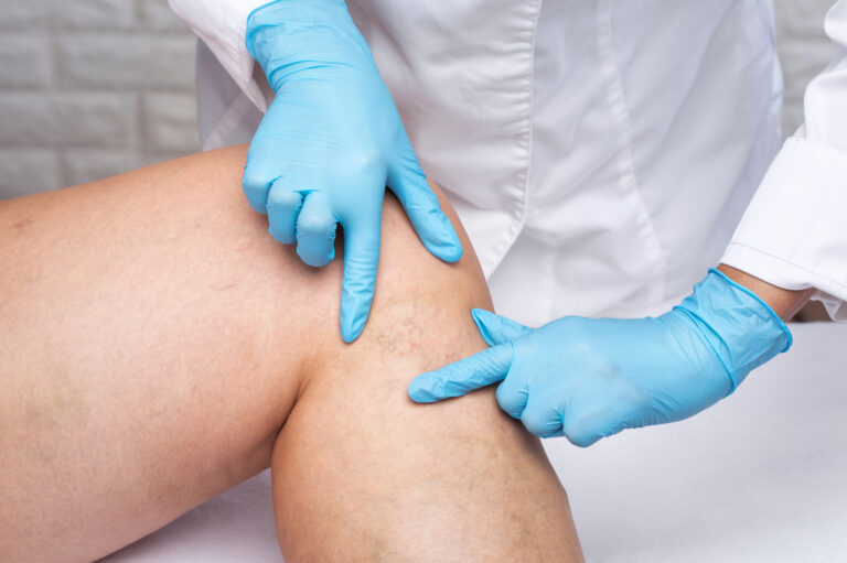 Removal of varicose veins on the legs. Medical inspection and treatment of Chronic Venous Insufficiency (CVI).